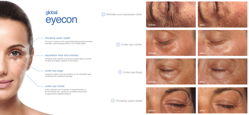 Global Eyecone Treatment